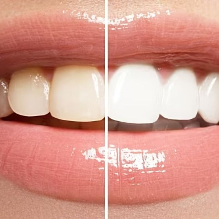 PLATINUM TEETH WHITENING