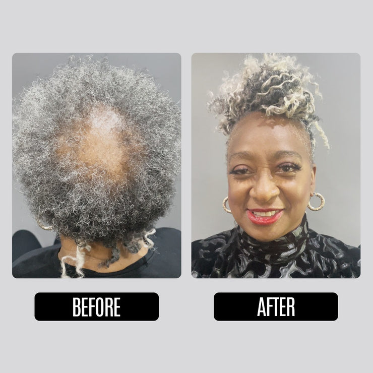 Alopecia Care (Add-ons)